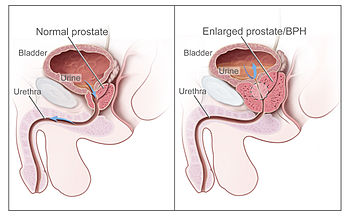 5 Alpha Reductase Inhibitors And Benign Prostatic Hyperplasia 5 Alpha Reductase Inhibitors And Benign Prostatic Hyperplasia