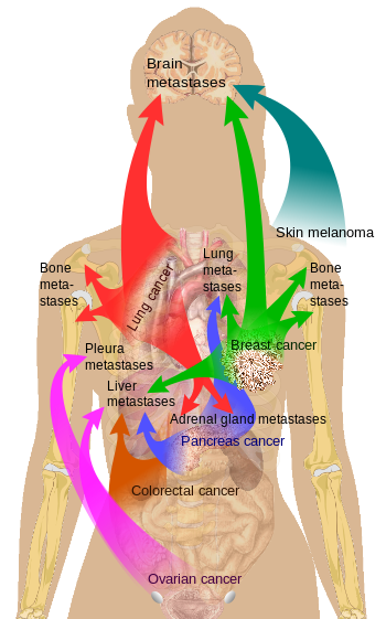 Main sites of metastases for some common cance... Main sites of metastases for some common cance...