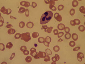 Blood smear of a patient with Iron deficiency ... Blood smear of a patient with Iron deficiency ...