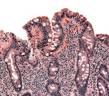 Biopsy of small bowel showing coeliac disease ... Biopsy of small bowel showing coeliac disease ...